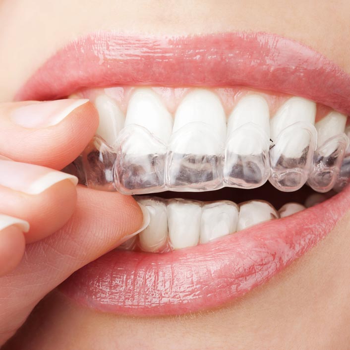 Invisalign® - Dental Services